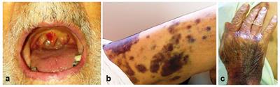 <mark class="highlighted">Immune Thrombocytopenia</mark> in a Very Elderly Patient With Covid-19